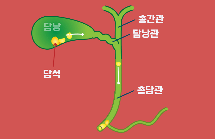 담석증 vs 담낭염 차이