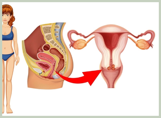 자궁경부 이형성증