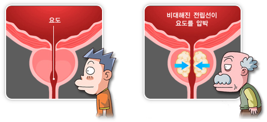 전립선비대증-원인