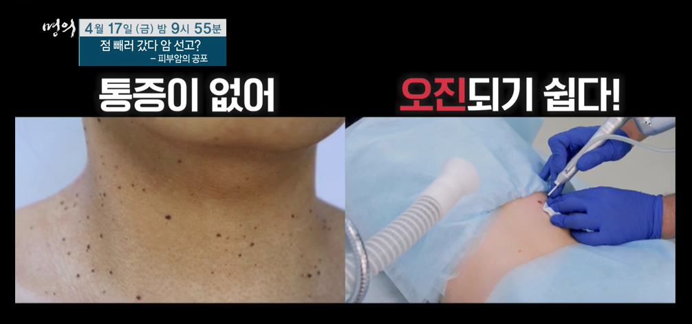 명의 피부암 점 구별법