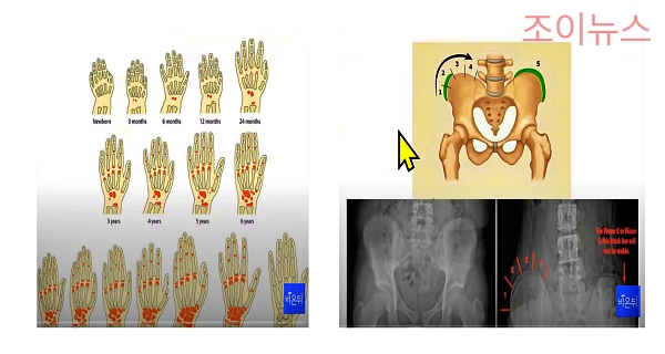 병원에서의 성장판 검사_출처:의학채널 비온뒤