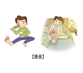통풍 증상&middot;원인&middot;치료까지 - 젊은 통풍환자 급증