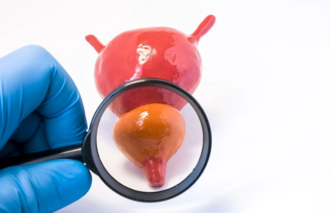 전립선염 원인 증상 자가진단 총정리