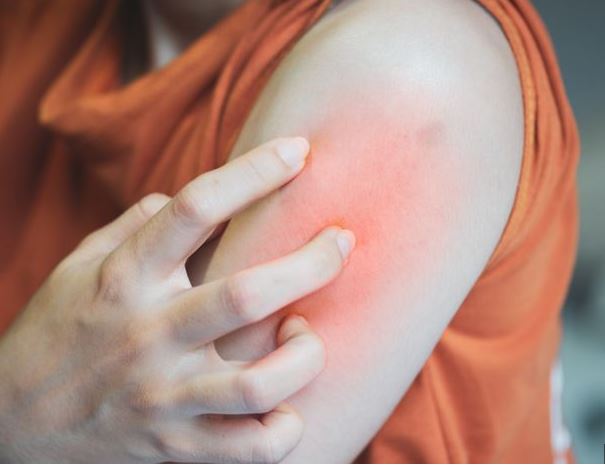 아이유-스키터증후군