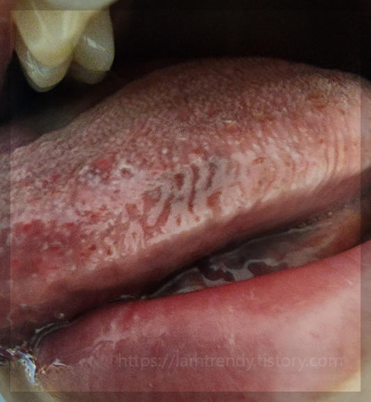 각질과 함께 진해지는 검은 점