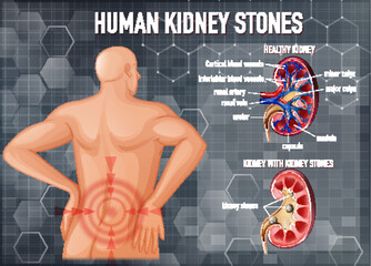 요로결석의 효과적 관리법: 좋은 음식과 피해야 할 음식