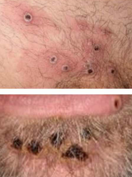 원숭이두창 증상