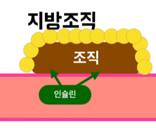 인슐린저항성