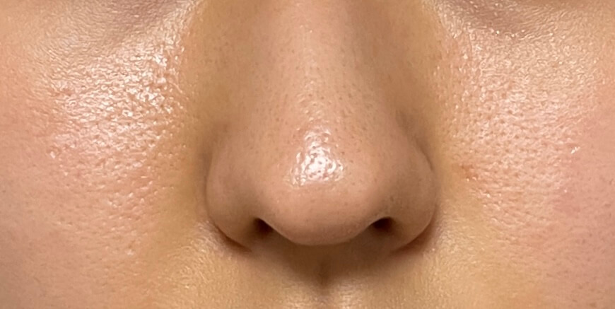 성분에디터 그린토마토 포어리프팅 앰플플러스 사용 9주차(8/14사진)