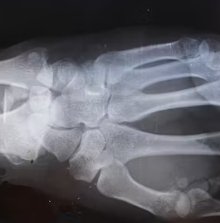 골다공증에 좋은 음식 예방 식단