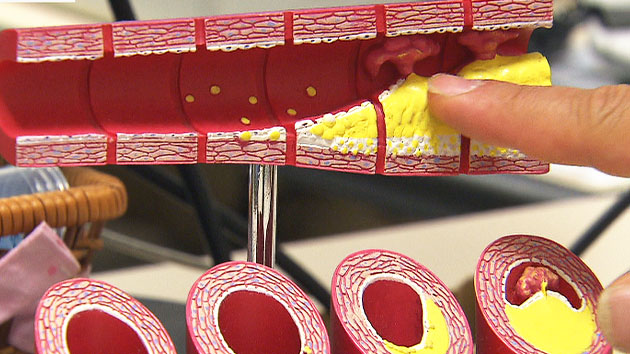 대동맥 죽상경화증