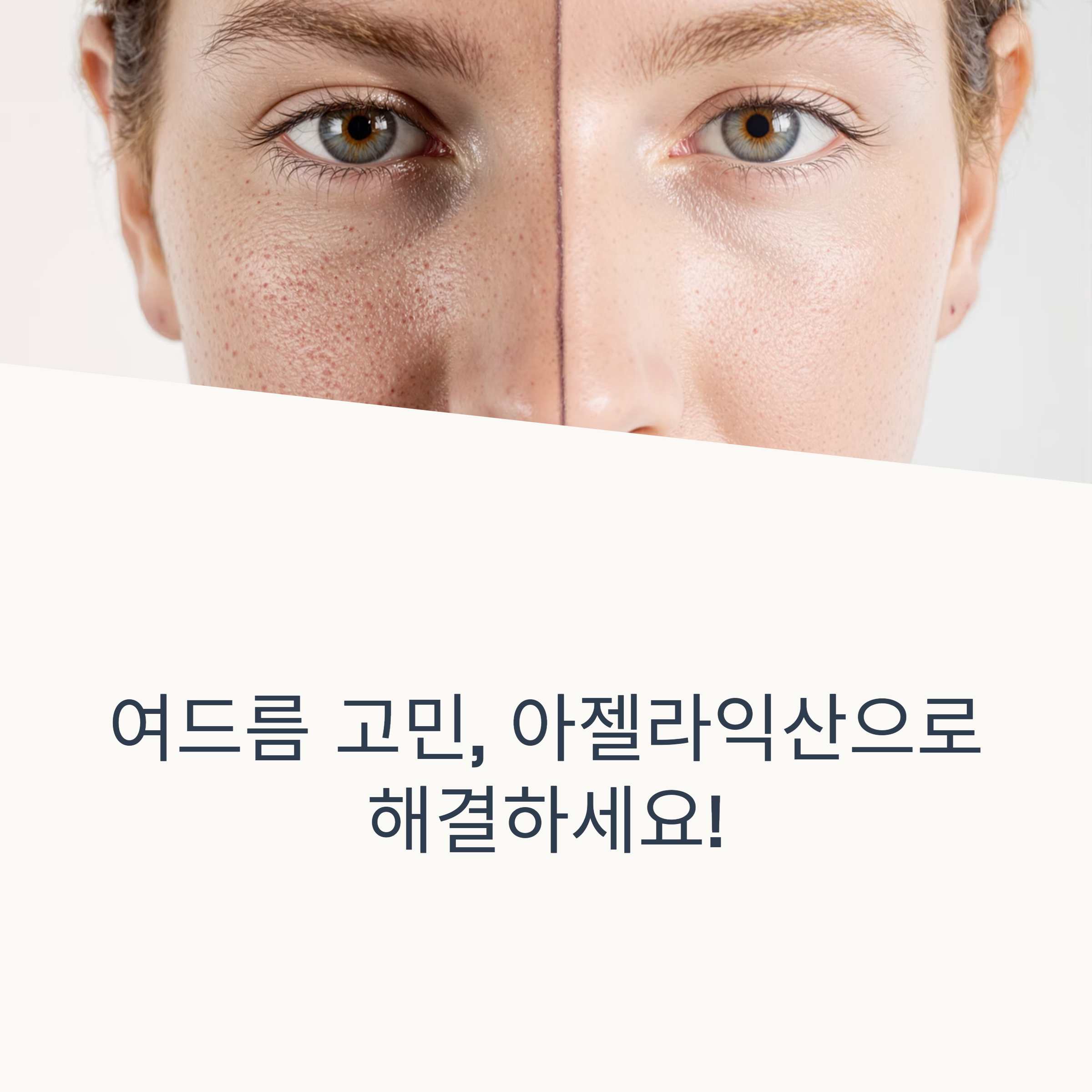 아젤라익산의 여드름 및 피부결 개선 효과