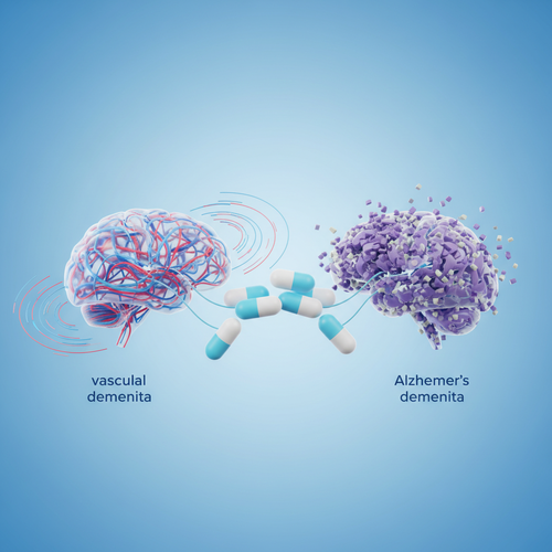 혈관성 치매를 넘어 알츠하이머 치매까지?