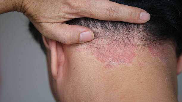 두피와 얼굴에 흔한 지루성 피부염! 악화 요인, 생활습관 관리법