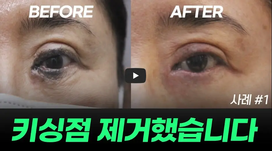 키싱점 제거 사례 영상
