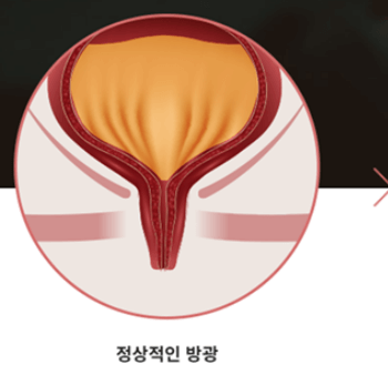 요실금_수술_후_회복기간_부작용_비용_보험적용여부