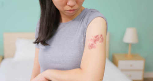 대상포진 전염성 초기증상 감염 원인 치료 병원