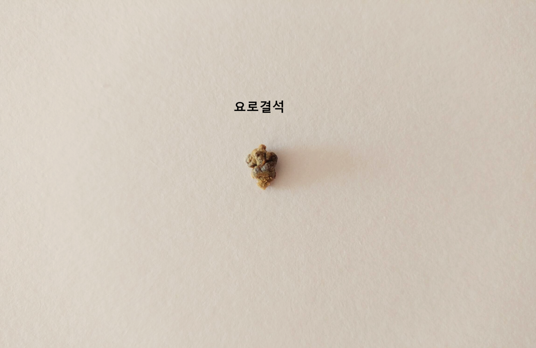 소변으로 나온 결석
