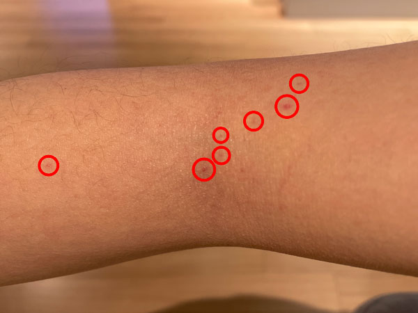 대상포진 초기증상 사진 - 띠 모양의 발진