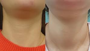 목주름 없애는 비결