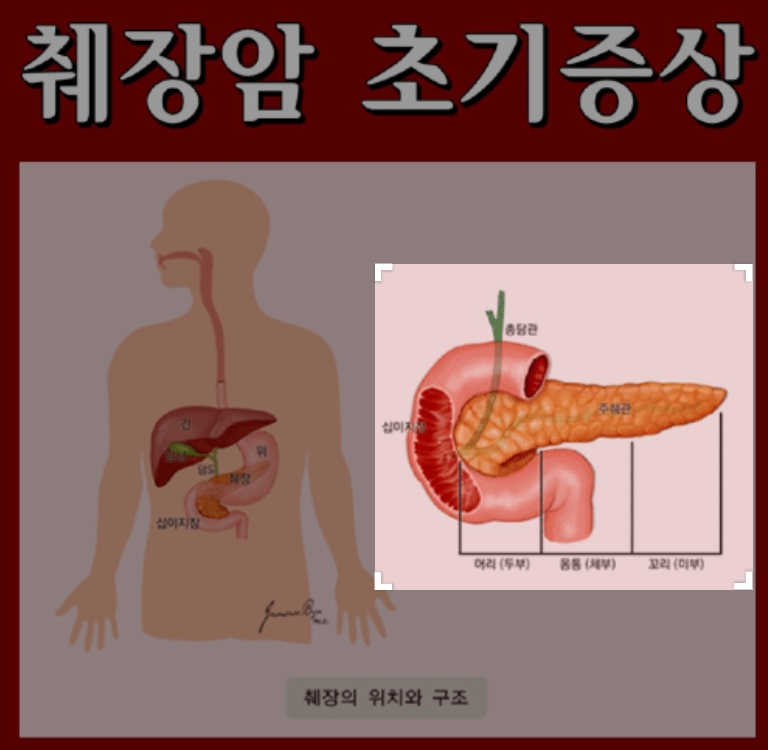 췌장암