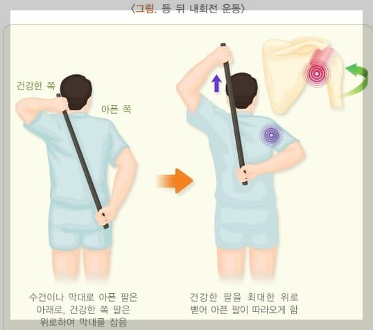 오십견-운동