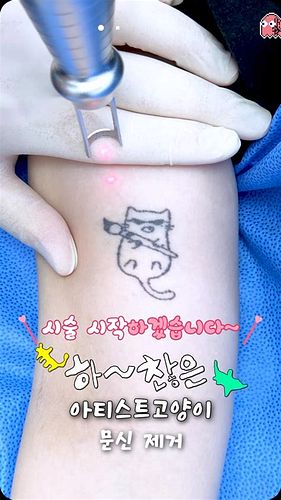 타투 지우는 비용