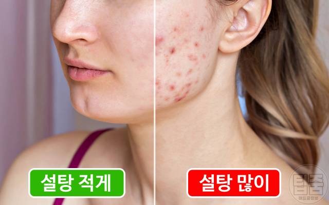 설탕 많이 먹으면 여드름 피부발진 설탕부작용