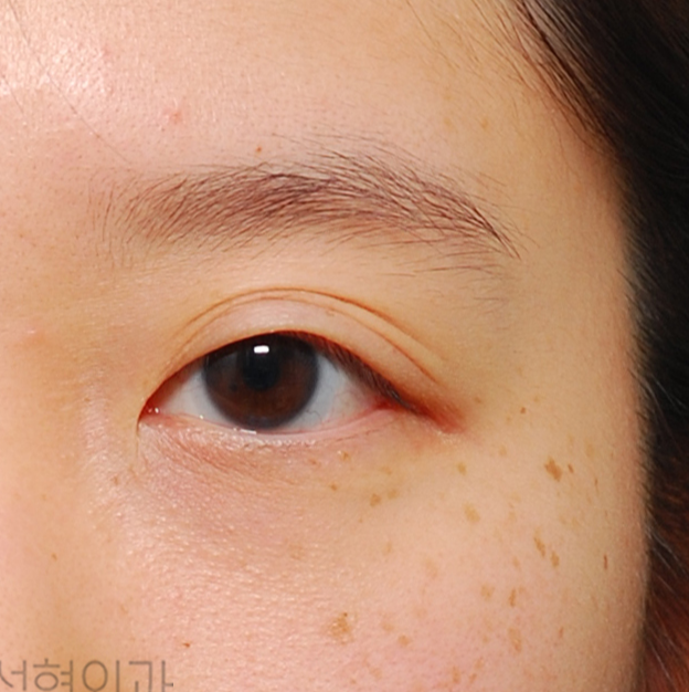 쌍수 붓기가 오래가는 이유- 높은 라인으로 잡은 경우
