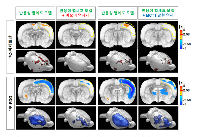 알츠하이머 치료제 최신 정보와 미래 전망
