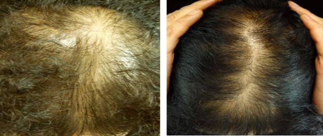 미녹시딜정-효과