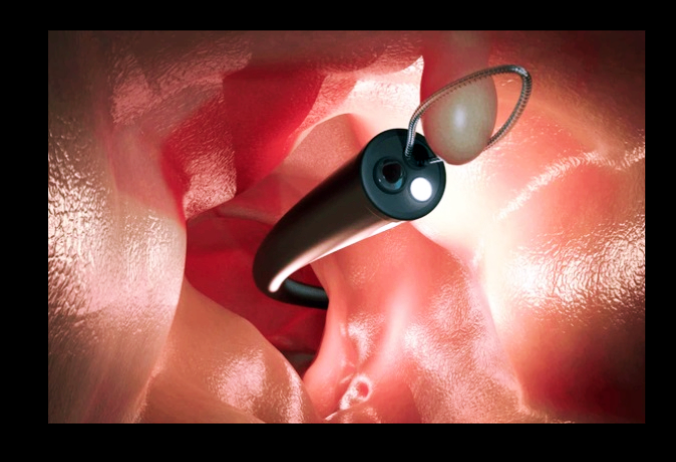 용종제거-시술-사진