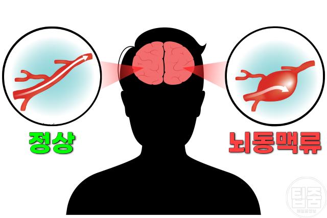 뇌동맥류 증상 뇌혈관 팽창