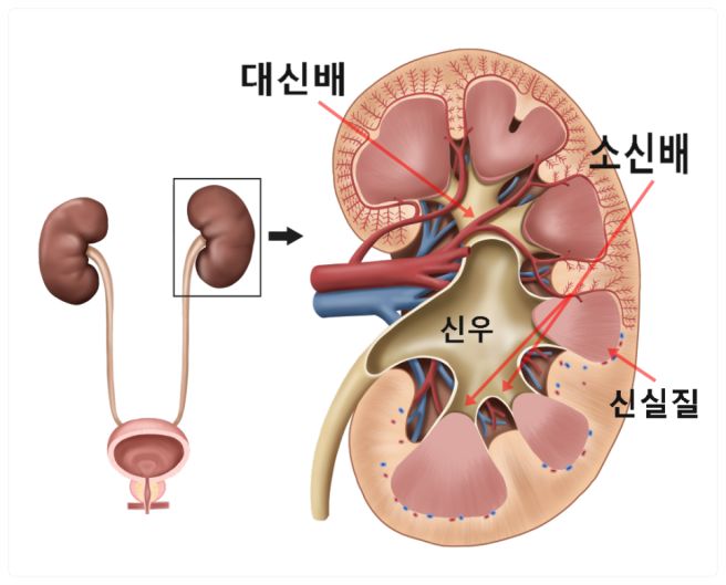 급성 신우신염 증상