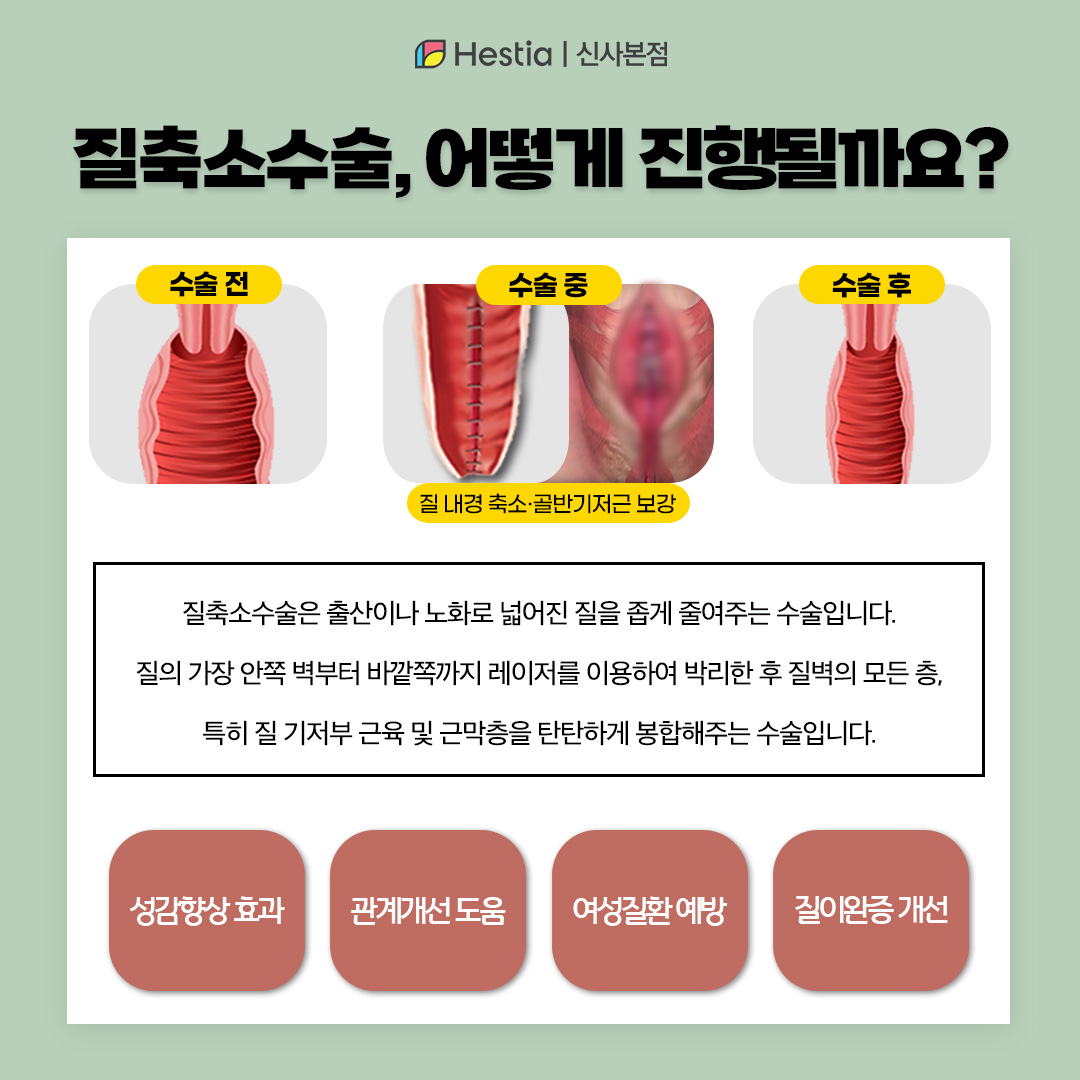 질축소수술 어떻게 진행되나요?