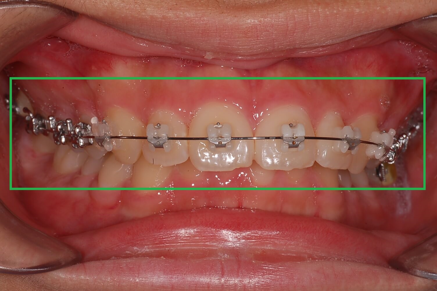 부정교합 가위교합 과개교합 치아교정 후기17