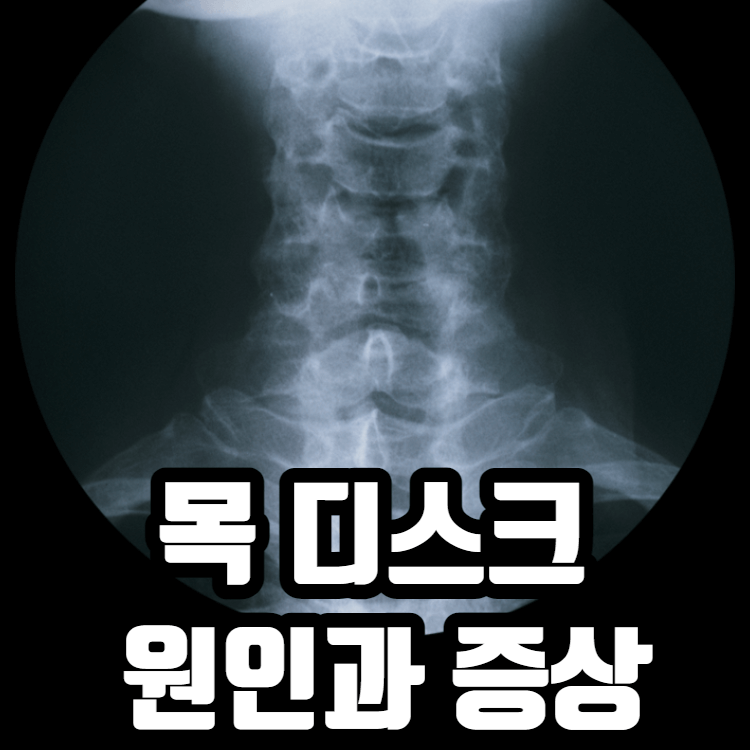 목 디스크 원인과 증상