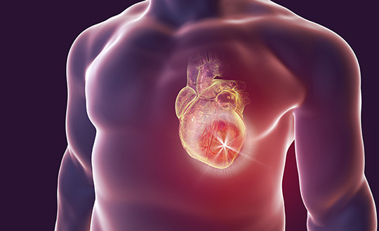 심근경색 초기증상