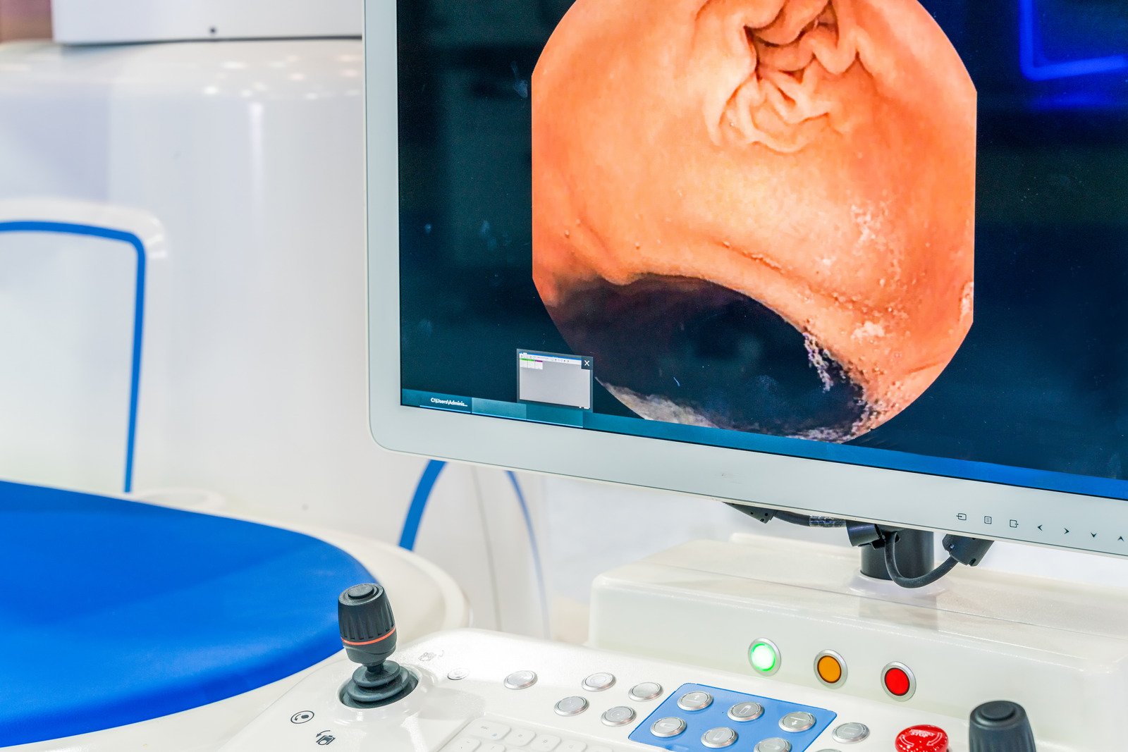 역류성 식도염(GERD: Gastroesophageal Reflux Disease)