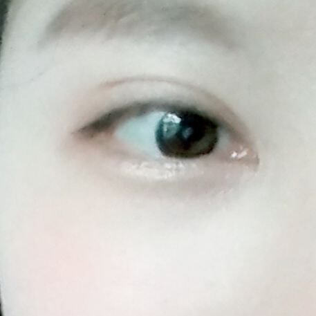 눈밑지방재배치 후기