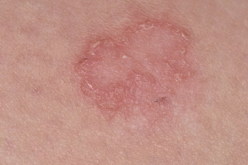 백선 원인, 치료 방법, 완치를 위한 생활관리