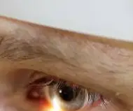 녹내장 초기 증상 &mdash; 시야를 서서히 빼앗는 침묵의 질환