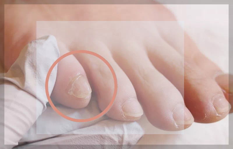 새끼발가락 내성 발톱 치료