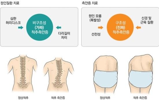 척추측만증 증상