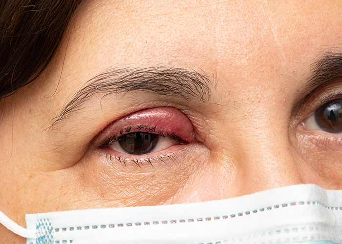 여성의 눈꺼풀이 눈다래끼로 심각하게 부어있다