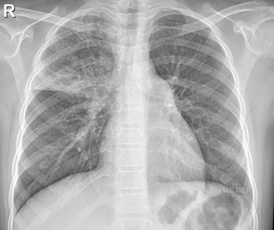 마이코플라스마 폐렴 전염 증상