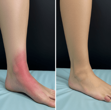 발목 통증 원인과 치료방법20