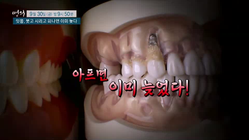 명의 붓고, 시리고, 피나면 이미 늦는 치주염 잇몸 질환 치주질환 치료, 예방 방법