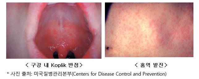 베트남 홍역 증상 - 구강내 반점