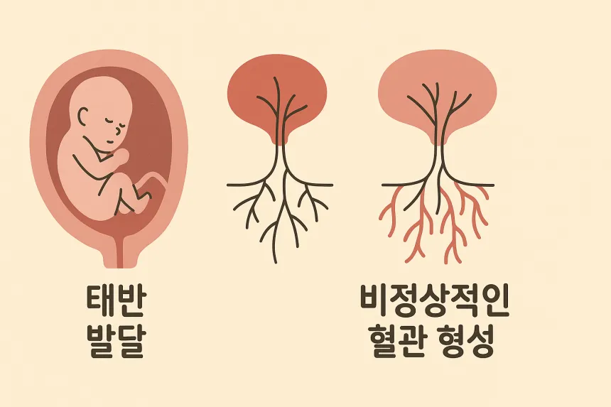 임신중독증 원인